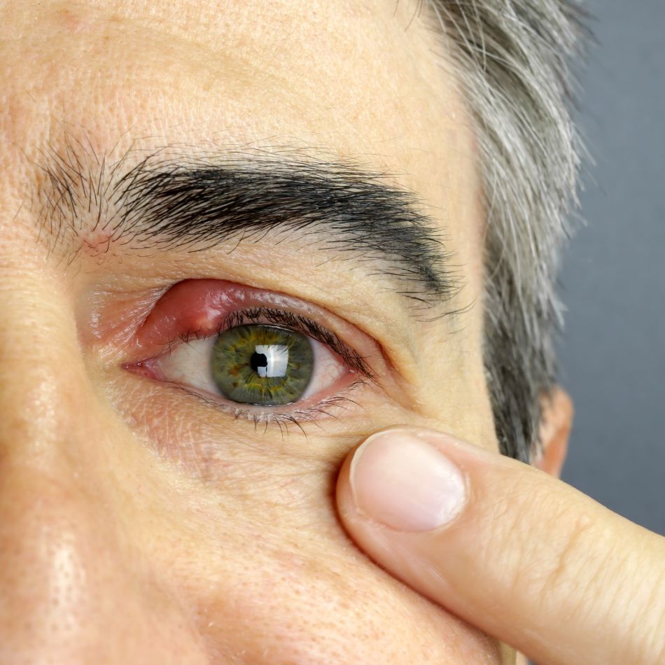 Chalazion image 1