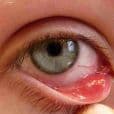 Chalazion image 2