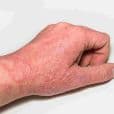 Eczema image 2