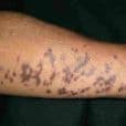 Lichen Planus