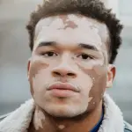 Vitiligo
